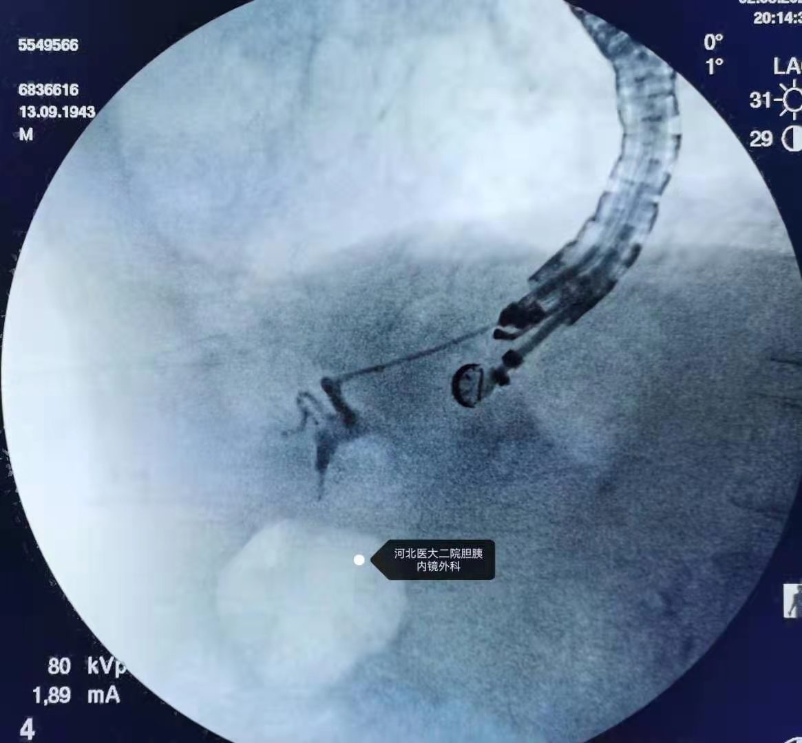 分享一例胃大部切除术后胆总管结石ERCP_胆胰内镜网